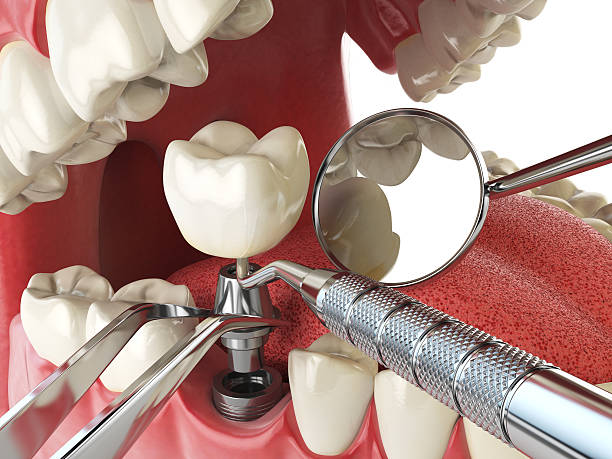Best Emergency Tooth Extraction in Lake Leann, MI